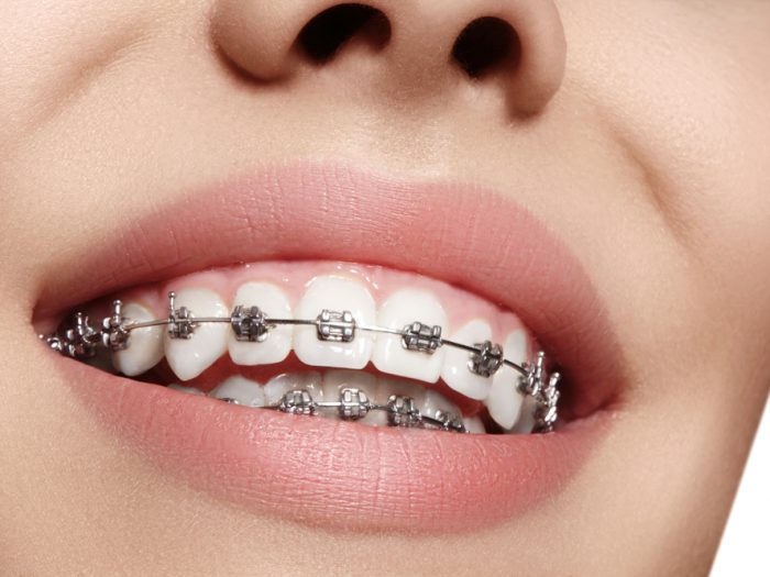 pikirkan Sebelum Pasang Kawat Gigi Behel Gigi